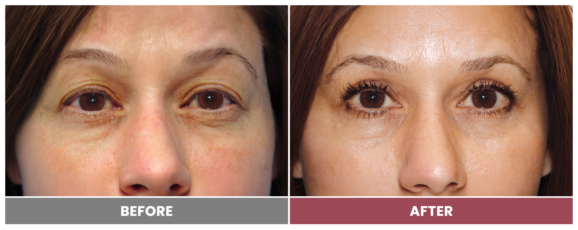 Upper Blepharoplasty - Case 41